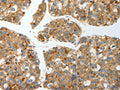 The image on the left is immunohistochemistry of paraffin-embedded Human liver cancer tissue using CSB-PA921139(PRCP Antibody) at dilution 1/15, on the right is treated with fusion protein. (Original magnification: ×200)