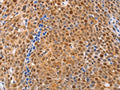The image on the left is immunohistochemistry of paraffin-embedded Human ovarian cancer tissue using CSB-PA921264(DUSP4 Antibody) at dilution 1/30, on the right is treated with fusion protein. (Original magnification: ×200)