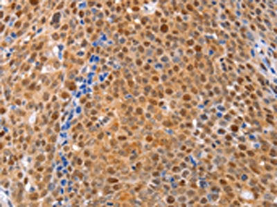 The image on the left is immunohistochemistry of paraffin-embedded Human ovarian cancer tissue using CSB-PA921264(DUSP4 Antibody) at dilution 1/30, on the right is treated with fusion protein. (Original magnification: ×200)