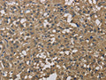 The image on the left is immunohistochemistry of paraffin-embedded Human thyroid cancer tissue using CSB-PA921442(DCTN3 Antibody) at dilution 1/50, on the right is treated with fusion protein. (Original magnification: ×200)