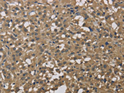 The image on the left is immunohistochemistry of paraffin-embedded Human thyroid cancer tissue using CSB-PA921442(DCTN3 Antibody) at dilution 1/50, on the right is treated with fusion protein. (Original magnification: ×200)