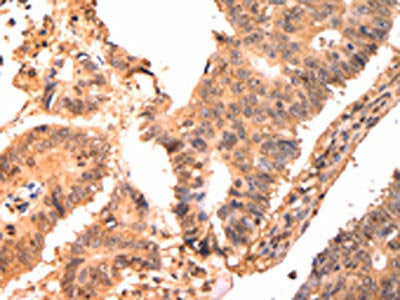 The image on the left is immunohistochemistry of paraffin-embedded Human colon cancer tissue using CSB-PA921513(CAPNS1 Antibody) at dilution 1/15, on the right is treated with fusion protein. (Original magnification: ×200)
