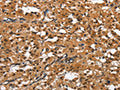 The image on the left is immunohistochemistry of paraffin-embedded Human thyroid cancer tissue using CSB-PA921557(SLAMF8 Antibody) at dilution 1/50, on the right is treated with fusion protein. (Original magnification: ×200)