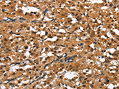 The image on the left is immunohistochemistry of paraffin-embedded Human thyroid cancer tissue using CSB-PA921557(SLAMF8 Antibody) at dilution 1/50, on the right is treated with fusion protein. (Original magnification: ×200)