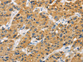 The image on the left is immunohistochemistry of paraffin-embedded Human liver cancer tissue using CSB-PA921825(BTLA Antibody) at dilution 1/30, on the right is treated with fusion protein. (Original magnification: ×200)