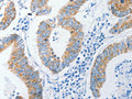 The image on the left is immunohistochemistry of paraffin-embedded Human colon cancer tissue using CSB-PA922061(DAP3 Antibody) at dilution 1/15, on the right is treated with fusion protein. (Original magnification: ×200)