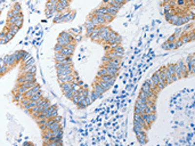 The image on the left is immunohistochemistry of paraffin-embedded Human colon cancer tissue using CSB-PA922061(DAP3 Antibody) at dilution 1/15, on the right is treated with fusion protein. (Original magnification: ×200)