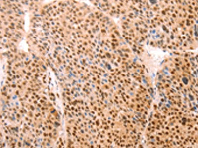 The image on the left is immunohistochemistry of paraffin-embedded Human liver cancer tissue using CSB-PA922317(ALYREF Antibody) at dilution 1/15, on the right is treated with synthetic peptide. (Original magnification: ×200)