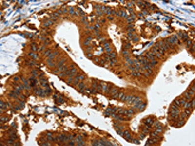 The image on the left is immunohistochemistry of paraffin-embedded Human colon cancer tissue using CSB-PA922324(IL20RA Antibody) at dilution 1/35, on the right is treated with fusion protein. (Original magnification: ×200)
