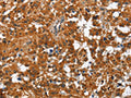 The image on the left is immunohistochemistry of paraffin-embedded Human thyroid cancer tissue using CSB-PA922459(PAK2 Antibody) at dilution 1/50, on the right is treated with fusion protein. (Original magnification: ×200)