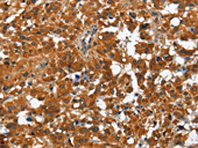 The image on the left is immunohistochemistry of paraffin-embedded Human thyroid cancer tissue using CSB-PA922459(PAK2 Antibody) at dilution 1/50, on the right is treated with fusion protein. (Original magnification: ×200)