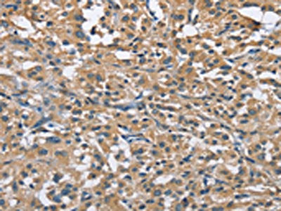 The image on the left is immunohistochemistry of paraffin-embedded Human thyroid cancer tissue using CSB-PA922469(FLT3 Antibody) at dilution 1/30, on the right is treated with fusion protein. (Original magnification: ×200)