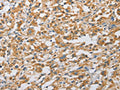 The image on the left is immunohistochemistry of paraffin-embedded Human thyroid cancer tissue using CSB-PA923194(ARHGAP5 Antibody) at dilution 1/25, on the right is treated with fusion protein. (Original magnification: ×200)