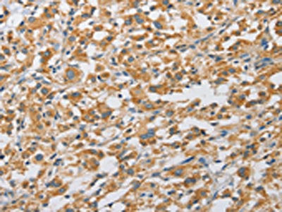 The image on the left is immunohistochemistry of paraffin-embedded Human thyroid cancer tissue using CSB-PA923194(ARHGAP5 Antibody) at dilution 1/25, on the right is treated with fusion protein. (Original magnification: ×200)