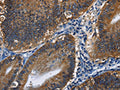 The image on the left is immunohistochemistry of paraffin-embedded Human colon cancer tissue using CSB-PA923298(CD46 Antibody) at dilution 1/30, on the right is treated with fusion protein. (Original magnification: ×200)