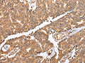 The image on the left is immunohistochemistry of paraffin-embedded Human prostate cancer tissue using CSB-PA923366(UQCRC2 Antibody) at dilution 1/25, on the right is treated with fusion protein. (Original magnification: ×200)