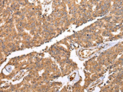 The image on the left is immunohistochemistry of paraffin-embedded Human prostate cancer tissue using CSB-PA923366(UQCRC2 Antibody) at dilution 1/25, on the right is treated with fusion protein. (Original magnification: ×200)
