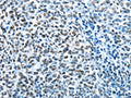 The image on the left is immunohistochemistry of paraffin-embedded Human ovarian cancer tissue using CSB-PA923713(CREB1 Antibody) at dilution 1/15, on the right is treated with fusion protein. (Original magnification: ×200)