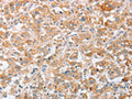 The image on the left is immunohistochemistry of paraffin-embedded Human thyroid cancer tissue using CSB-PA923782(SIGLEC9 Antibody) at dilution 1/40, on the right is treated with fusion protein. (Original magnification: ×200)
