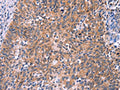 The image on the left is immunohistochemistry of paraffin-embedded Human cervical cancer tissue using CSB-PA924161(EDN1 Antibody) at dilution 1/50, on the right is treated with fusion protein. (Original magnification: ×200)