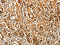 The image on the left is immunohistochemistry of paraffin-embedded Human gastic cancer tissue using CSB-PA924165(FSHR Antibody) at dilution 1/70, on the right is treated with fusion protein. (Original magnification: ×200)