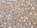 The image on the left is immunohistochemistry of paraffin-embedded Human thyroid cancer tissue using CSB-PA924394(PIKFYVE Antibody) at dilution 1/30, on the right is treated with fusion protein. (Original magnification: ×200)