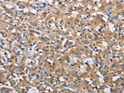 The image on the left is immunohistochemistry of paraffin-embedded Human thyroid cancer tissue using CSB-PA924394(PIKFYVE Antibody) at dilution 1/30, on the right is treated with fusion protein. (Original magnification: ×200)