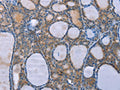The image on the left is immunohistochemistry of paraffin-embedded Human thyroid cancer tissue using CSB-PA924414(OPTN Antibody) at dilution 1/25, on the right is treated with fusion protein. (Original magnification: ×200)
