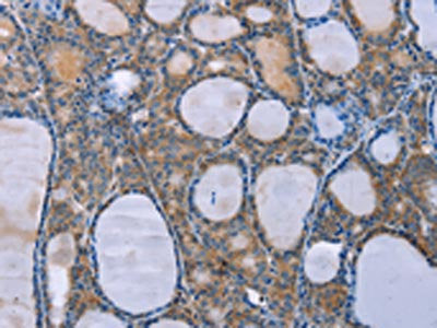 The image on the left is immunohistochemistry of paraffin-embedded Human thyroid cancer tissue using CSB-PA924414(OPTN Antibody) at dilution 1/25, on the right is treated with fusion protein. (Original magnification: ×200)
