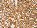 The image on the left is immunohistochemistry of paraffin-embedded Human thyroid cancer tissue using CSB-PA924465(ATG4D Antibody) at dilution 1/40, on the right is treated with fusion protein. (Original magnification: ×200)