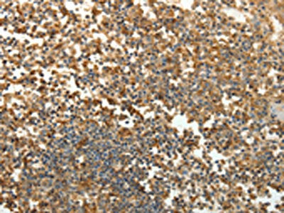 The image on the left is immunohistochemistry of paraffin-embedded Human tonsil tissue using CSB-PA924520(SFTPD Antibody) at dilution 1/30, on the right is treated with fusion protein. (Original magnification: ×200)