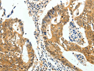 The image on the left is immunohistochemistry of paraffin-embedded Human colon cancer tissue using CSB-PA924854(CDH23 Antibody) at dilution 1/60, on the right is treated with fusion protein. (Original magnification: ×200)