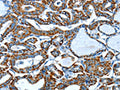 The image on the left is immunohistochemistry of paraffin-embedded Human thyroid cancer tissue using CSB-PA925196(ALDH6A1 Antibody) at dilution 1/45, on the right is treated with fusion protein. (Original magnification: ×200)