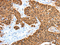The image on the left is immunohistochemistry of paraffin-embedded Human esophagus cancer tissue using CSB-PA925454(ADAMTS5 Antibody) at dilution 1/30, on the right is treated with synthetic peptide. (Original magnification: ×200)