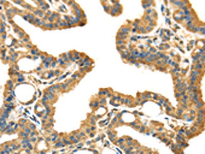 The image on the left is immunohistochemistry of paraffin-embedded Human thyroid cancer tissue using CSB-PA925610(IL3RA Antibody) at dilution 1/35, on the right is treated with synthetic peptide. (Original magnification: ×200)