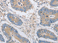 The image on the left is immunohistochemistry of paraffin-embedded Human colon cancer tissue using CSB-PA925792(OASL Antibody) at dilution 1/35, on the right is treated with fusion protein. (Original magnification: ×200)