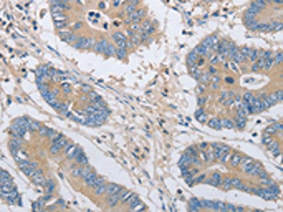 The image on the left is immunohistochemistry of paraffin-embedded Human colon cancer tissue using CSB-PA925792(OASL Antibody) at dilution 1/35, on the right is treated with fusion protein. (Original magnification: ×200)