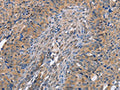 The image on the left is immunohistochemistry of paraffin-embedded Human cervical cancer tissue using CSB-PA925811(MAP2K1 Antibody) at dilution 1/20, on the right is treated with fusion protein. (Original magnification: ×200)