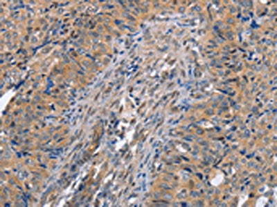The image on the left is immunohistochemistry of paraffin-embedded Human cervical cancer tissue using CSB-PA925811(MAP2K1 Antibody) at dilution 1/20, on the right is treated with fusion protein. (Original magnification: ×200)