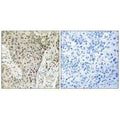 Immunohistochemistry analysis of paraffin-embedded human lung carcinoma tissue using ARHGEF19 antibody.