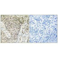 Immunohistochemistry analysis of paraffin-embedded human lung carcinoma tissue using ARHGEF19 antibody.