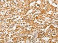 The image on the left is immunohistochemistry of paraffin-embedded Human thyroid cancer tissue using CSB-PA926103(APTX Antibody) at dilution 1/50, on the right is treated with fusion protein. (Original magnification: ×200)