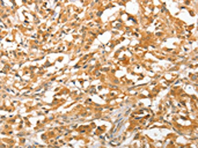 The image on the left is immunohistochemistry of paraffin-embedded Human thyroid cancer tissue using CSB-PA926103(APTX Antibody) at dilution 1/50, on the right is treated with fusion protein. (Original magnification: ×200)