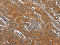 The image on the left is immunohistochemistry of paraffin-embedded Human gastic cancer tissue using CSB-PA926374(BLK Antibody) at dilution 1/20, on the right is treated with fusion protein. (Original magnification: ×200)