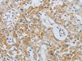 The image on the left is immunohistochemistry of paraffin-embedded Human lung cancer tissue using CSB-PA926432(MMP25 Antibody) at dilution 1/80, on the right is treated with synthetic peptide. (Original magnification: ×200)