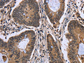 The image on the left is immunohistochemistry of paraffin-embedded Human colon cancer tissue using CSB-PA926721(FGFRL1 Antibody) at dilution 1/20, on the right is treated with fusion protein. (Original magnification: ×200)