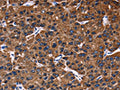 The image on the left is immunohistochemistry of paraffin-embedded Human liver cancer tissue using CSB-PA926901(PHB Antibody) at dilution 1/30, on the right is treated with fusion protein. (Original magnification: ×200)