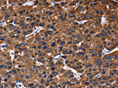 The image on the left is immunohistochemistry of paraffin-embedded Human liver cancer tissue using CSB-PA926901(PHB Antibody) at dilution 1/30, on the right is treated with fusion protein. (Original magnification: ×200)