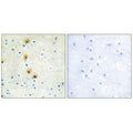 Immunohistochemistry analysis of paraffin-embedded human breast carcinoma tissue using Akt (Ab-326) antibody.