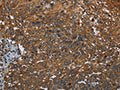 The image on the left is immunohistochemistry of paraffin-embedded Human cervical cancer tissue using CSB-PA927147(IL2RG Antibody) at dilution 1/20, on the right is treated with fusion protein. (Original magnification: ×200)